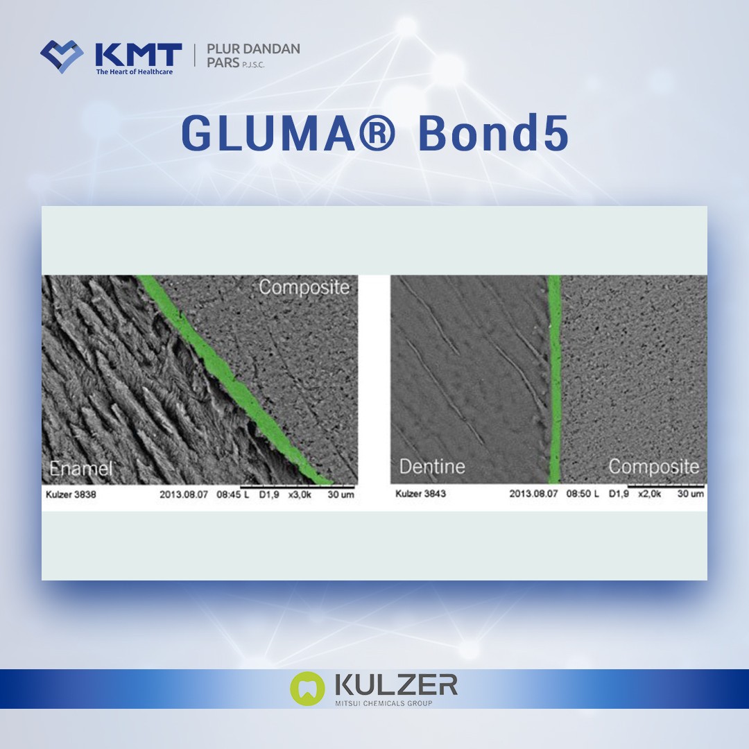 gluma bond5 chart 3