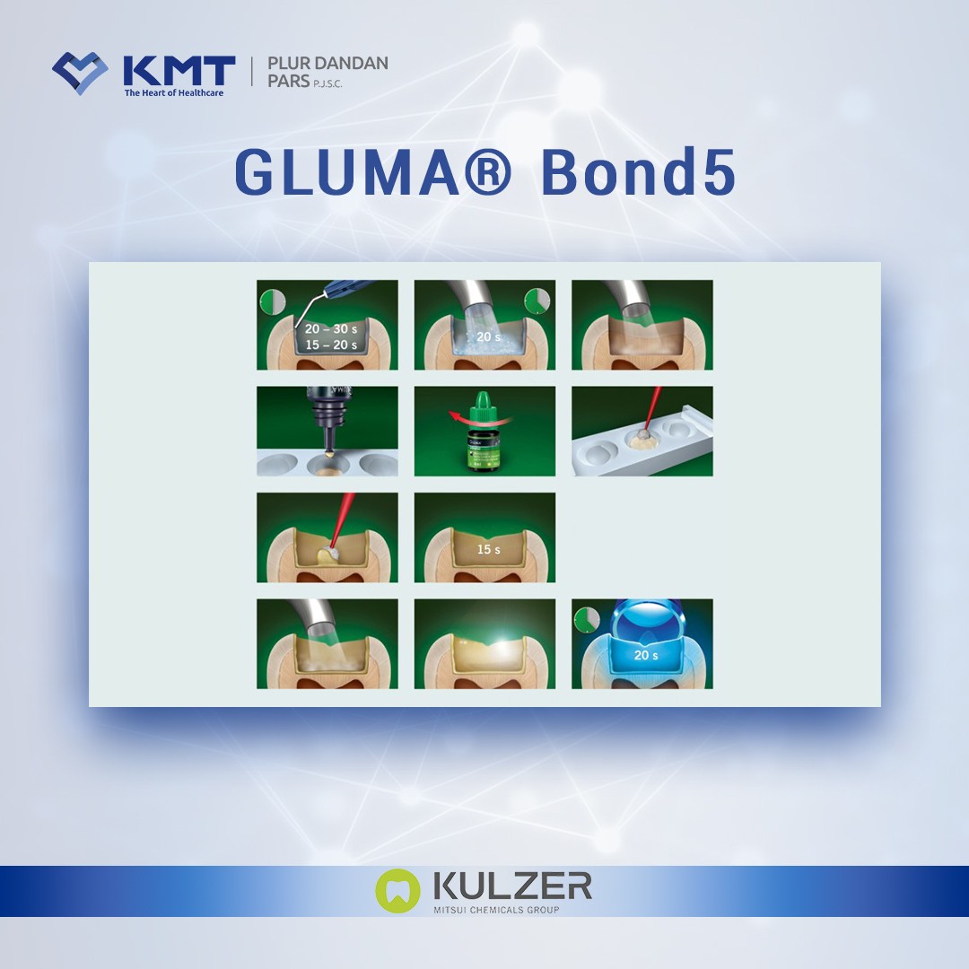 gluma bond5 chart 2