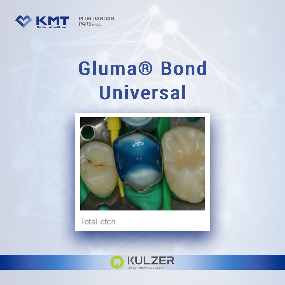 gluma bond universal chart  20