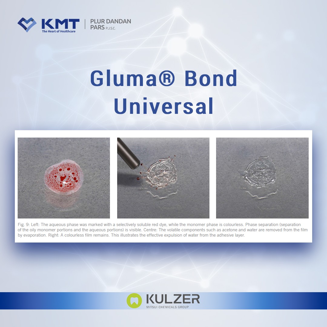 gluma bond universal chart  25