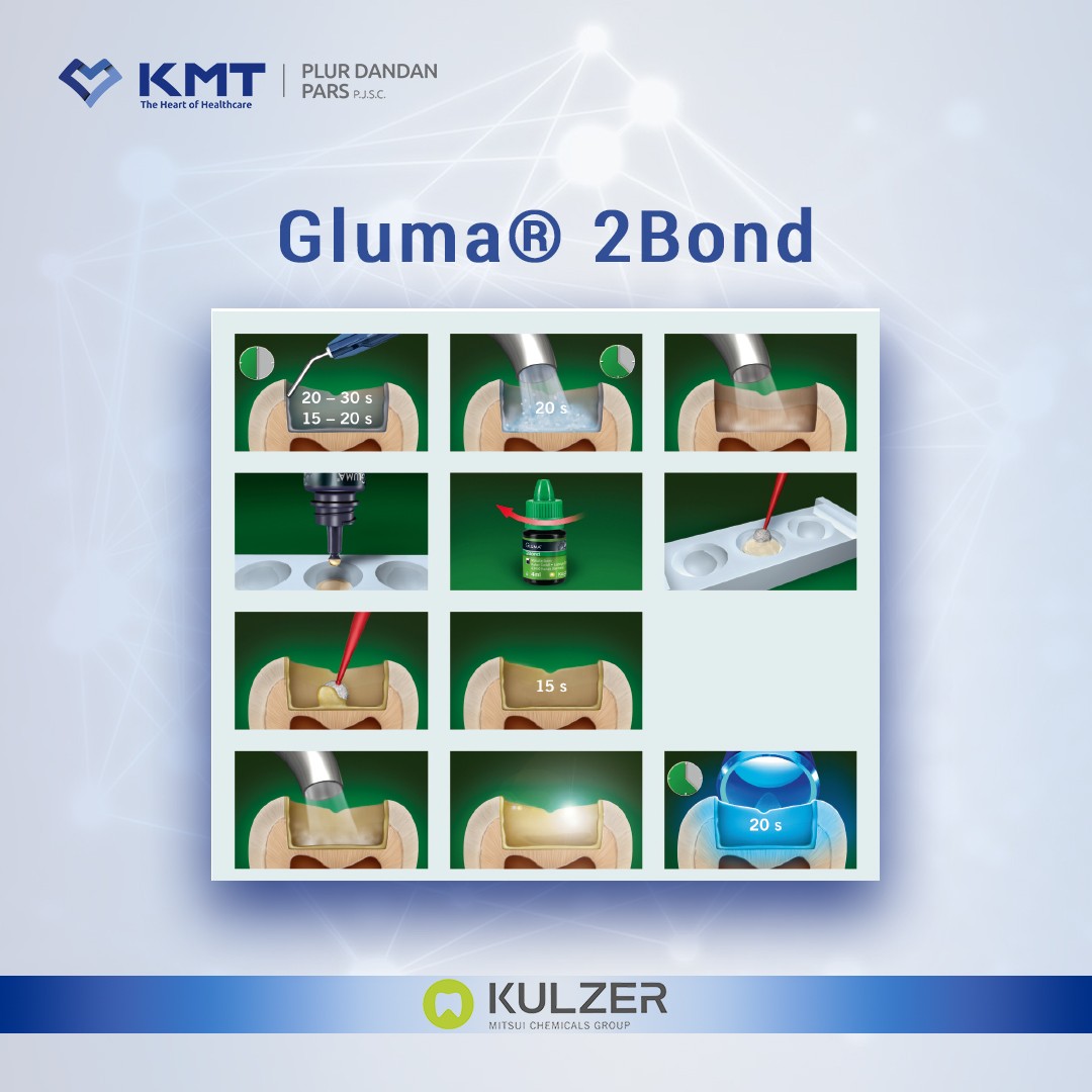 gluma 2 bond chart 4